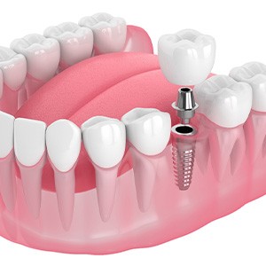Illustration of a single dental implant