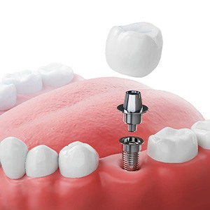 Illustration of dental crown being attached to dental implant