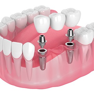 Illustration of an implant bridge