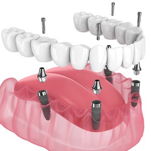 Illustration of an implant denture