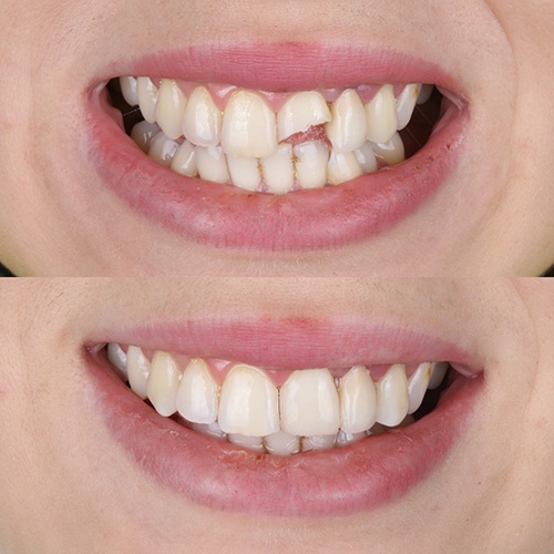 Before and after cosmetic bonding