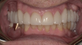 Smile after dental treatment