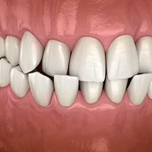 Illustration of misaligned teeth