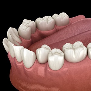 Illustration of crowded teeth