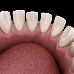 Illustration of teeth with gaps