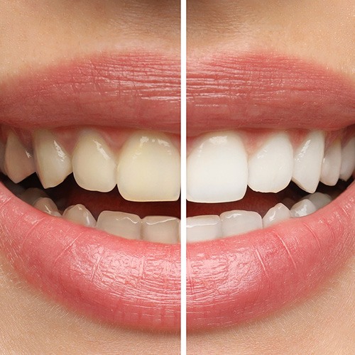 Closeup picture of a smile that’s split in half to show before/after treatment results