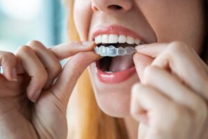 Woman removing clear aligner. 