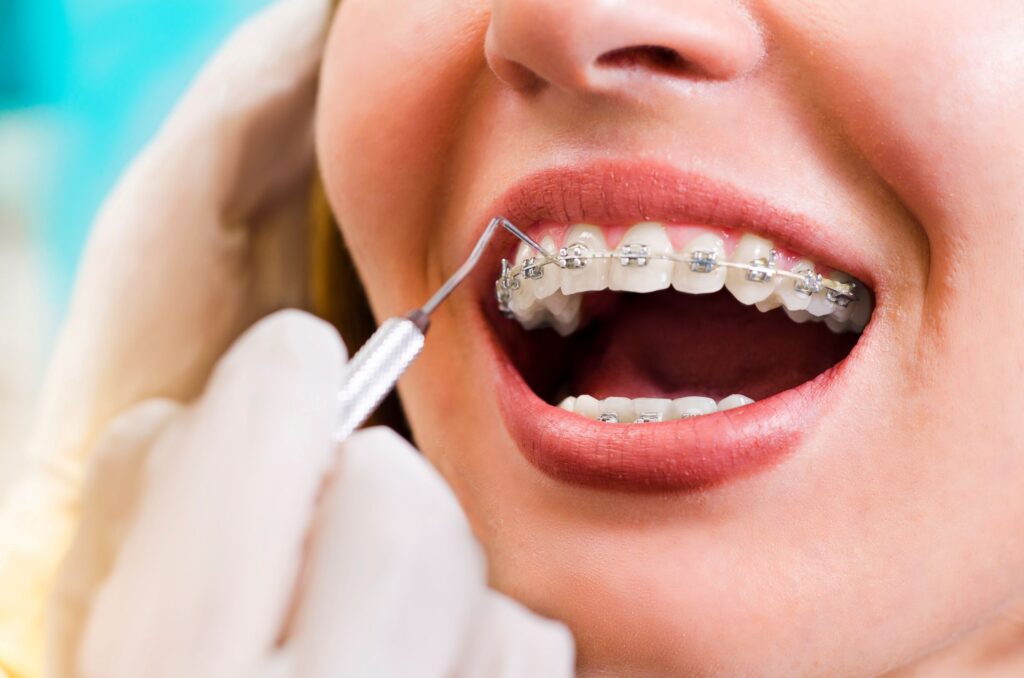 Nose-to-chin closeup of patient's braces being examined by dentist